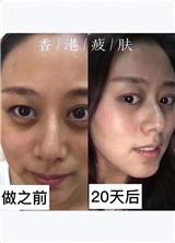 膚詩華娜祛斑價格