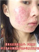 去除紅血絲面膜,芙柯面膜