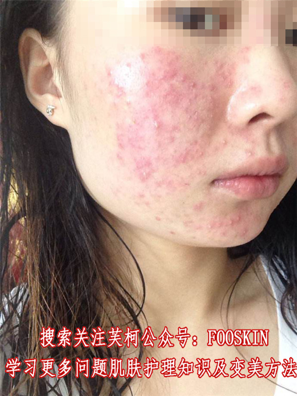 去除紅血絲面膜,芙柯面膜